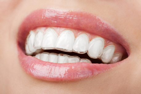 Chennai, Businesses For Sale, Braces & Teeth Straightening Methods