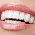 Braces & Teeth Straightening Methods