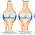 Best Knee Specialist In Mumbai | Advanced Knee Care & Treatment
