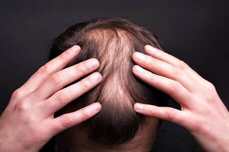 London, Beautician, Say Goodbye To Hair Loss - Try Alopecia Treatment UK