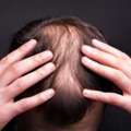 Say Goodbye To Hair Loss - Try Alopecia Treatment UK
