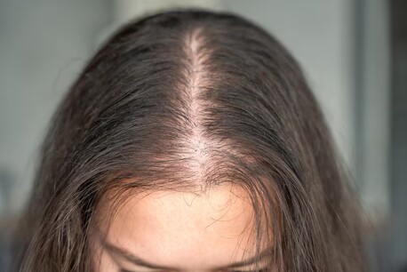 London, Beautician, Say Goodbye To Hair Loss - Try Alopecia Treatment UK