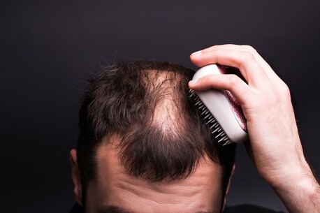 London, Beautician, Say Goodbye To Hair Loss - Try Alopecia Treatment UK