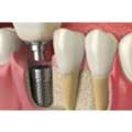 Dental Implants Melbourne