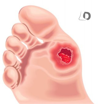 Houston, Medical, Diabetic Foot Wound Specialist For Advanced Healing Care