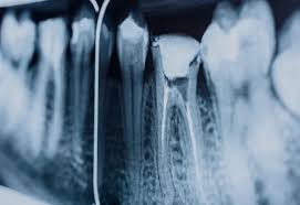 Singapore, Dental, Root Canal Treatment In Singapore: Is It Worth The Investment?