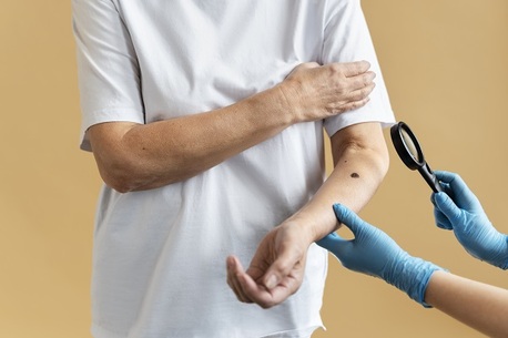 New York, Health, Trusted Wart Infection Care Treatment In NYC