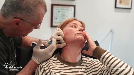 Cape Town, Beautician, Advanced Skin Renewal With Micro Needling Treatment