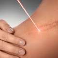 Stretch Marks Treatment