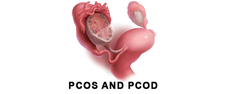 Ghaziabad, Health, Best Hospital For PCOD And PCOS Treatment