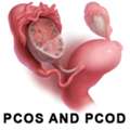 Best Hospital For PCOD And PCOS Treatment