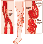 Gurgaon, Health, Varicose Veins Treatment Gurgaon