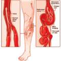 Varicose Veins Treatment Gurgaon