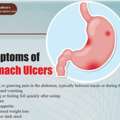 Symptoms Of Stomach Ulcers | Best Gastroenterologist In Bhubaneswar | Dr Satyaprakash Ray