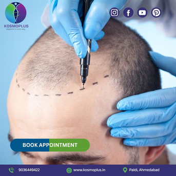 Ahmedabad, Health, Solve Your Hair Loss Problem With An Expert Hair Transplant In Ahmedabad