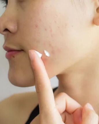 New York, Business, Acne Treatment In Kailua-Kona