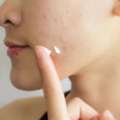 Acne Treatment In Kailua-Kona
