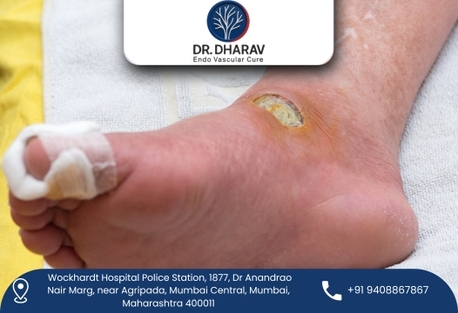 Mumbai, Health, Safe And Proven Treatment For Diabetic Foot Problems