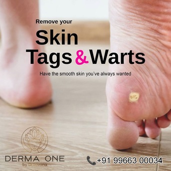 Visakhapatnam, Health, Skin Tag Removal Treatment - Derma One Clinic