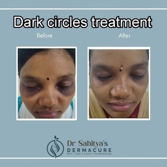 Kurnool, Health, Dark Circles Treatment At Dermacure