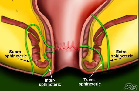 New Delhi, Health, Fistula Treatment In South Delhi