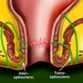 Fistula Treatment In South Delhi