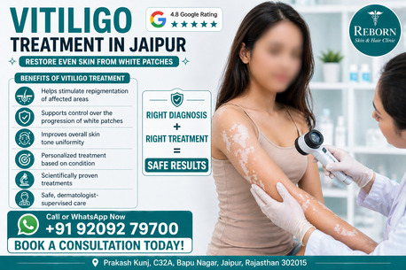 Jaipur, Health & Beauty Items, INR 5000,  Effective Vitiligo Treatment In Jaipur For White Patches On Skin