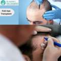 Get Fuller Hair With Expert FUE Hair Transplant In Hyderabad