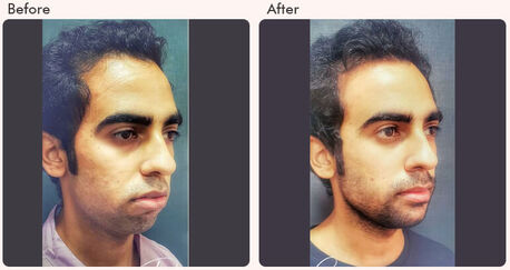 New Delhi, Health, Chin Augmentation In Delhi - Dr Rajat Gupta