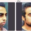 Chin Augmentation In Delhi - Dr Rajat Gupta