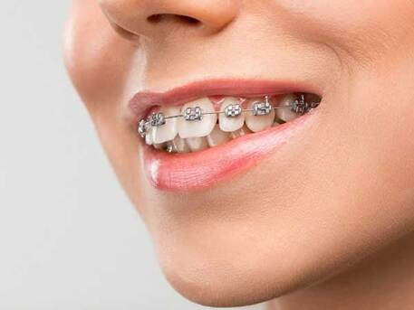 Jaipur, Dental, Affordable Orthodontist In Jaipur For Braces Treatment