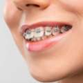 Affordable Orthodontist In Jaipur For Braces Treatment