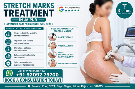 Jaipur, Health & Beauty Items, INR 3500,  Stretch Marks Treatment In Jaipur - Get Smooth Skin Today