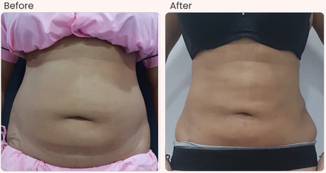 New Delhi, Health, Liposuction Surgery In Delhi - Dr Rajat Gupta