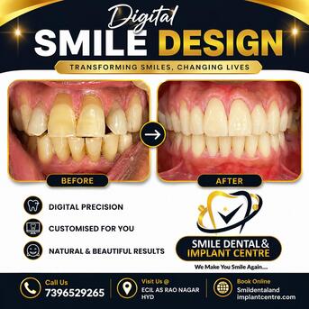 Hyderabad, Dental, Digital Smile Design In AS Rao Nagar, Hyderabad| Smile Dental & Implant Centre