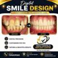Digital Smile Design In AS Rao Nagar, Hyderabad| Smile Dental & Implant Centre