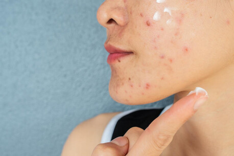 Noida, Health, Acne Treatment In Noida Clear Skin Solutions By Expert Dermatologists