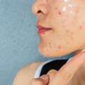 Acne Treatment In Noida Clear Skin Solutions By Expert Dermatologists