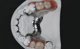 Shenzhen, Dental, Trusted Attachment Case Manufacturer In China