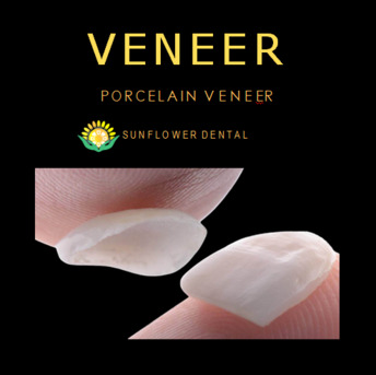 Beijing, Dental, Natural-Looking Non-Prep Veneers In China For Perfect Smiles