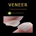 Natural-Looking Non-Prep Veneers In China For Perfect Smiles