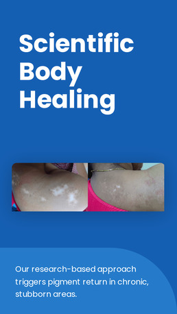 Faridabad, Health, Homeopathy Treatment For Leucoderma Faridabad