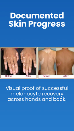 Faridabad, Health, Homeopathy Treatment For Leucoderma Faridabad