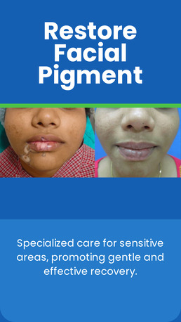 Faridabad, Health, Homeopathy Treatment For Leucoderma Faridabad
