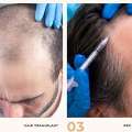 Hair Treatments In Ghaziabad