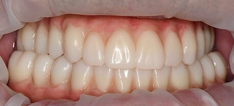 New York, Health, Permanent Tooth Replacement With Advanced Implant Solutions