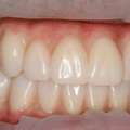 Permanent Tooth Replacement With Advanced Implant Solutions