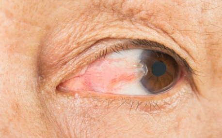 New York, Health, Pinguecula & Pterygium Treatment | EyeOC Eye Care Services