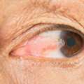 Pinguecula & Pterygium Treatment | EyeOC Eye Care Services
