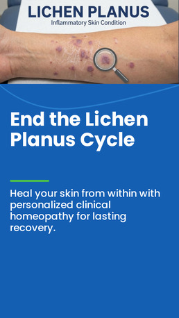 Faridabad, Health, Homeopathy Treatment For Lichen Plannus